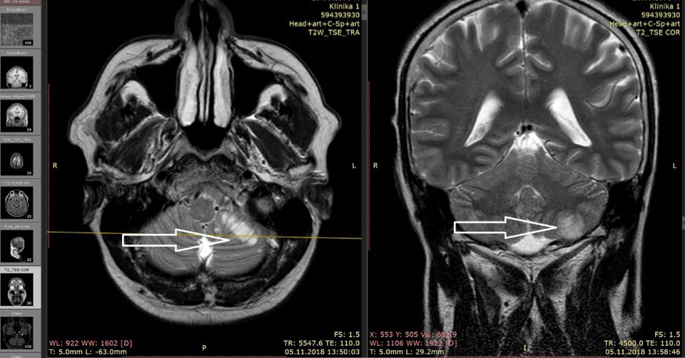 Мозжечок на кт. Мозжечковый инсульт мрт. Ишемический инсульт мозжечка кт.