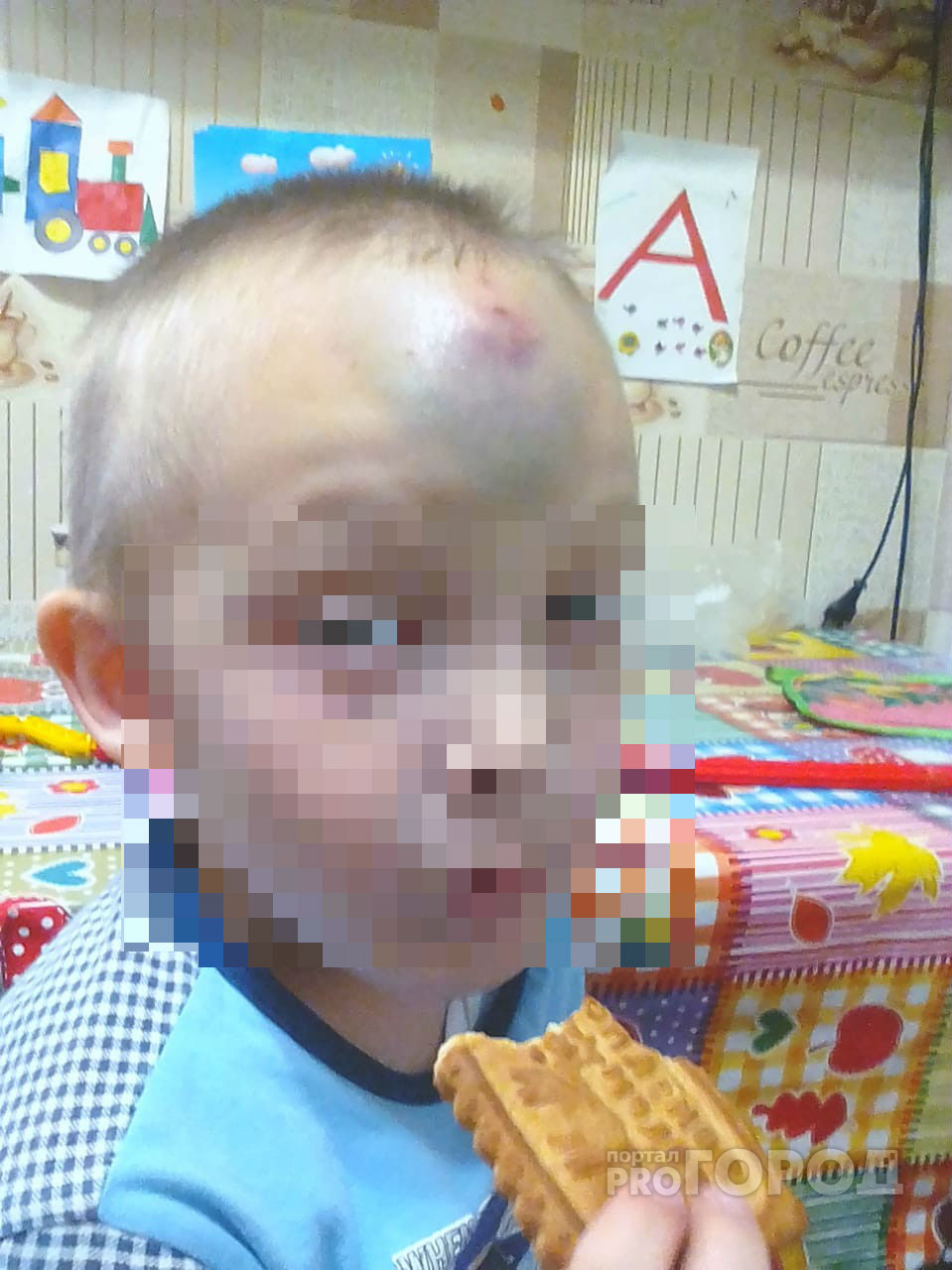 В Йошкар-Оле воспитателю садика сделали выговор за мальчика, получившего огромную гематому