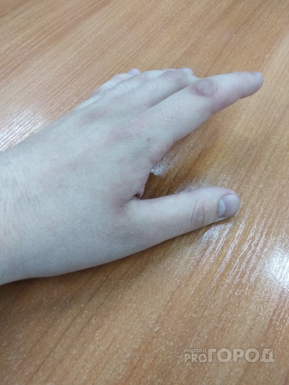 Флэшмоб: есть ли у йошкаролинцев шрам на указательном пальце левой руке?
