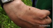 В Марий Эл выявлен первый случай заболевания клещевым боррелиозом