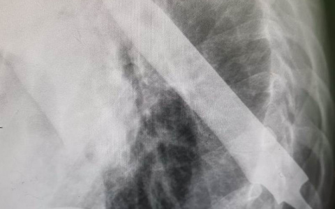 «Нож остался в спине без ручки»: житель Марий Эл попытался убить друга, но остановился на полпути